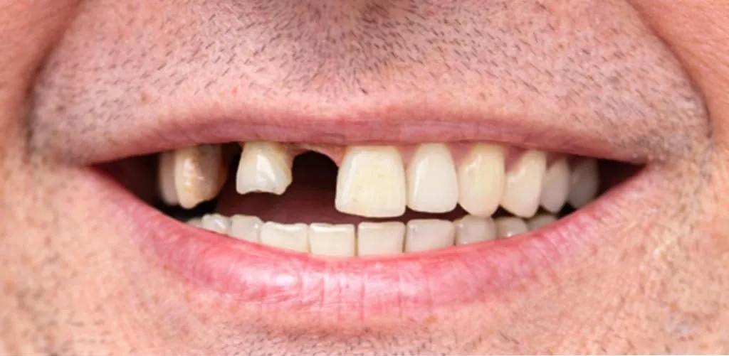 Antes: Dente da frente que faltava, reposto