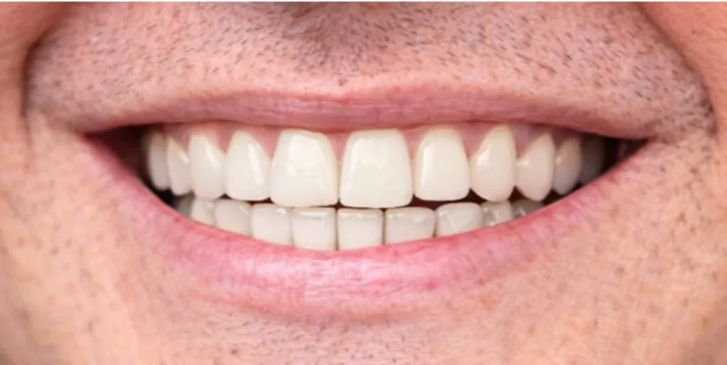 Depois: Dente da frente que faltava, reposto