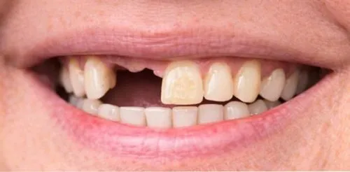 Antes: Espaço de um dente perdido, preenchido