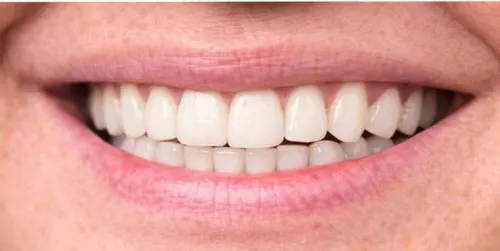 Depois: Espaço de um dente perdido, preenchido