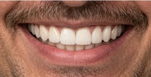 Depois: Dente que faltava na frente, reposto