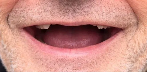 Antes: Quase sem dentes antes, sorriso completo depois