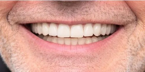Depois: Quase sem dentes antes, sorriso completo depois