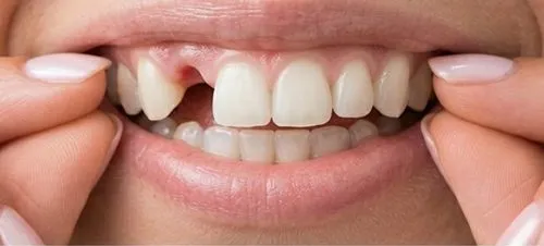 Antes: Dentes laterais que faltavam, repostos