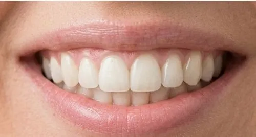Depois: Dentes laterais que faltavam, repostos