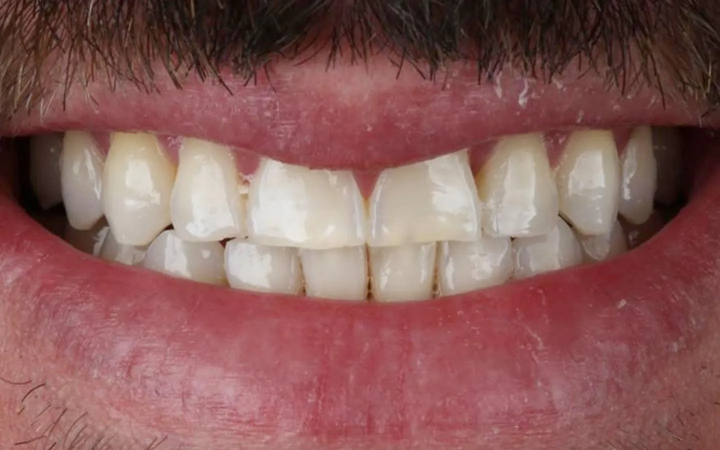 Antes: Dentes irregulares e escurecidos, depois uniformes e claros