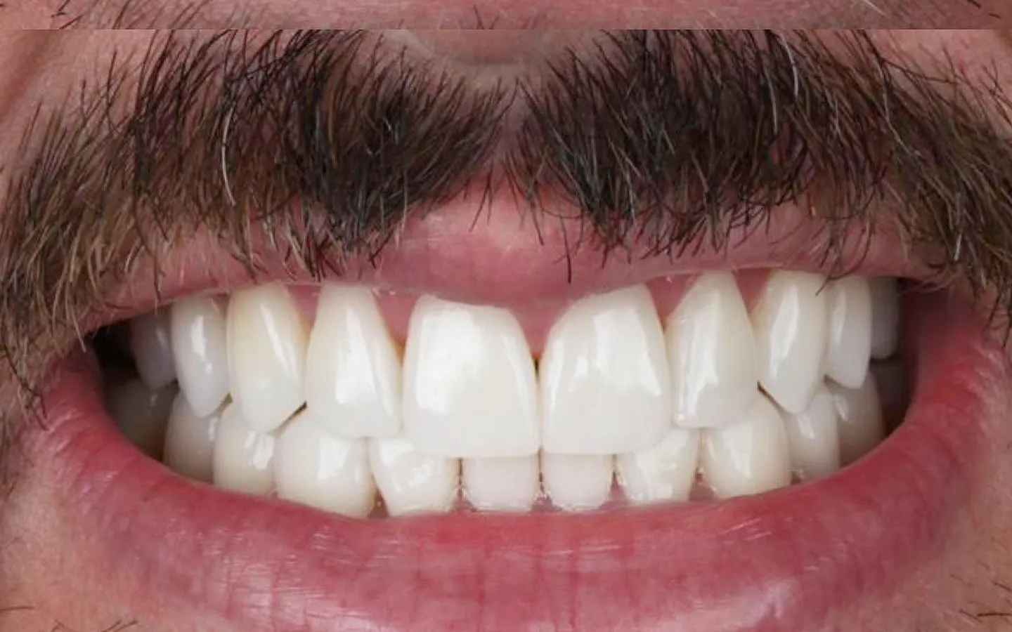 Depois: Dentes irregulares e escurecidos, depois uniformes e claros