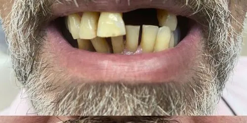 Antes: Dentes tortos e ausentes, sorriso refeito