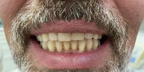 Depois: Dentes tortos e ausentes, sorriso refeito