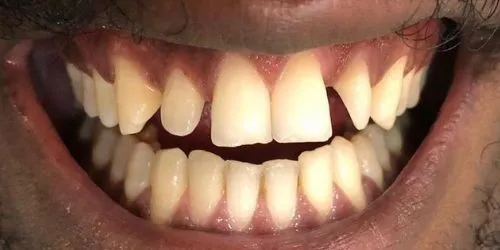 Antes: Espaço entre os dentes da frente, fechado