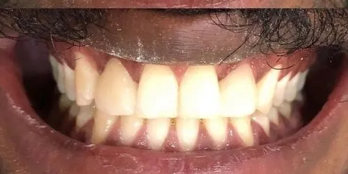 Depois: Espaço entre os dentes da frente, fechado