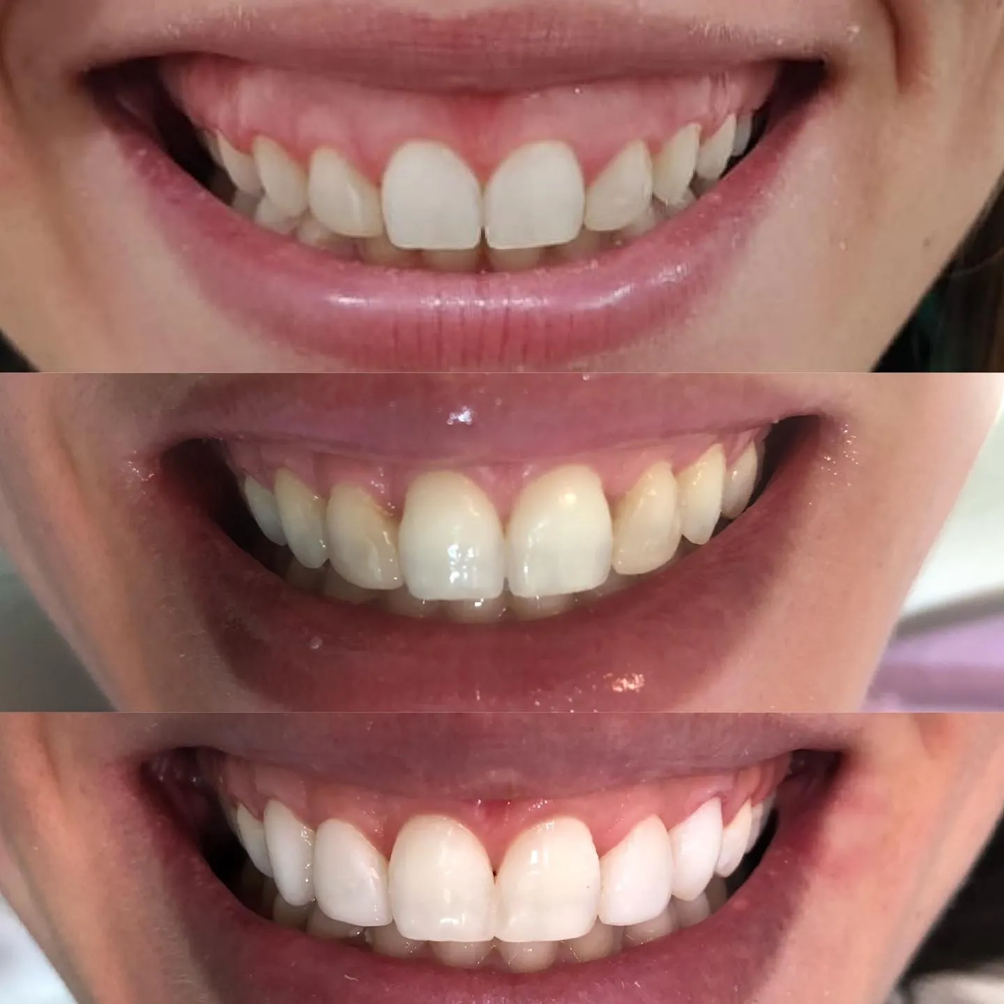 Antes, durante e depois: Três etapas do mesmo sorriso
