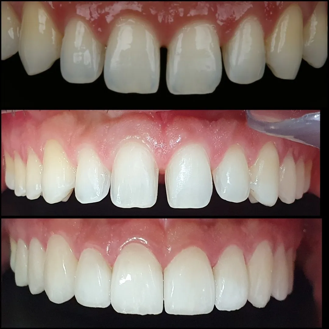 Antes, durante e depois: Espaços entre os dentes, fechados em três etapas