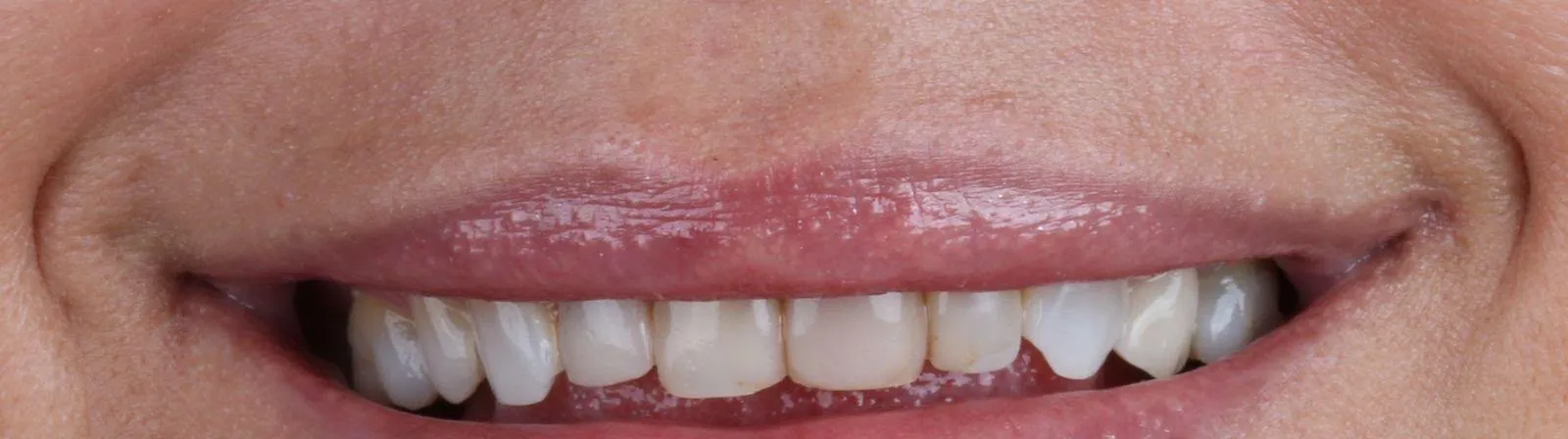 Antes: Lentes de contato de porcelana