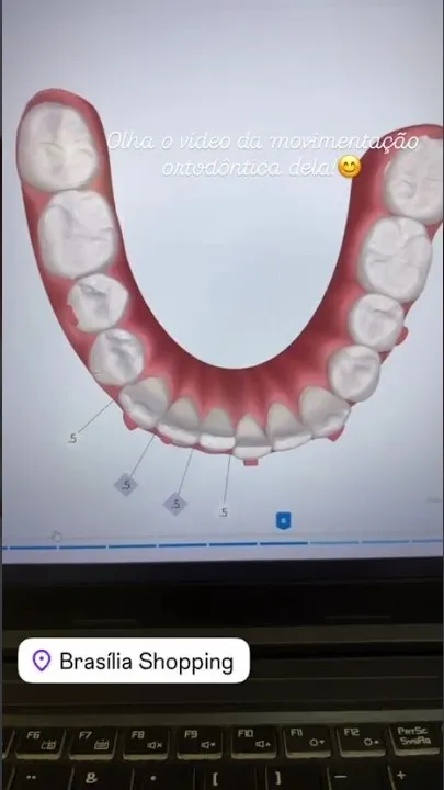 Simulação digital de uma arcada dentária na tela de um notebook, em quadro do vídeo