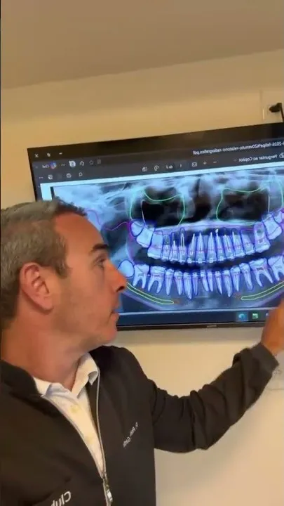 Dr. Rodrigo Garbim apontando uma radiografia panorâmica na tela, em quadro do vídeo